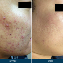 Load image into Gallery viewer, SkinPen® Microneedling
