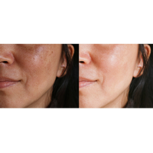 Load image into Gallery viewer, Motus AY Laser Treatment - Brown Spots
