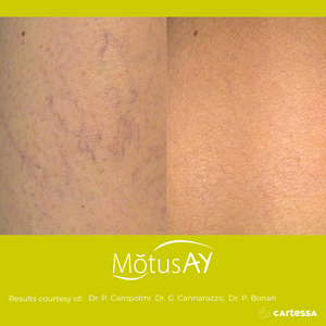 Motus AY Laser Treatment - Vessels