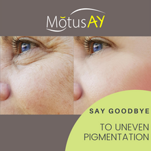Load image into Gallery viewer, Motus AY Laser Treatment - Brown Spots
