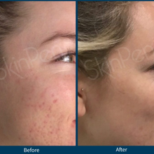 Load image into Gallery viewer, SkinPen® Microneedling
