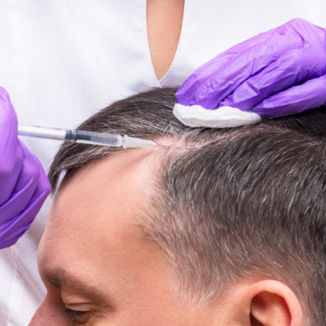 Hair Loss Scalp Injections with PRP (Service)